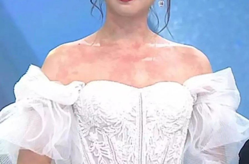 TVB女星胸口突然出现红疹，原因出人意料，曾因性格跳脱被导演责骂